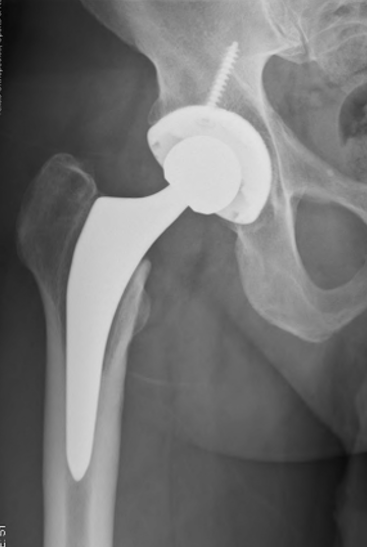 Potted Femoral Stem with Lucency - A