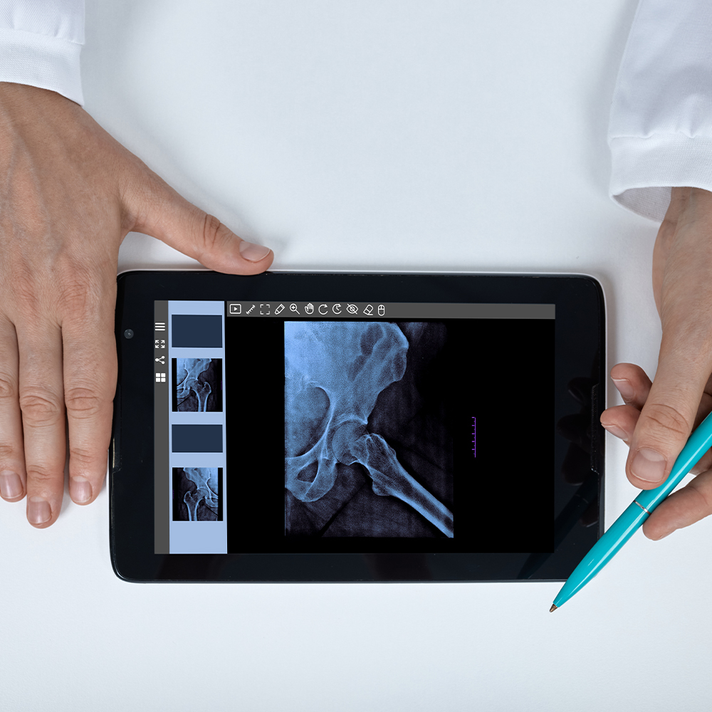 Doctor holding a pen over a pelvic hip joint X-ray scan displayed on a tablet computer