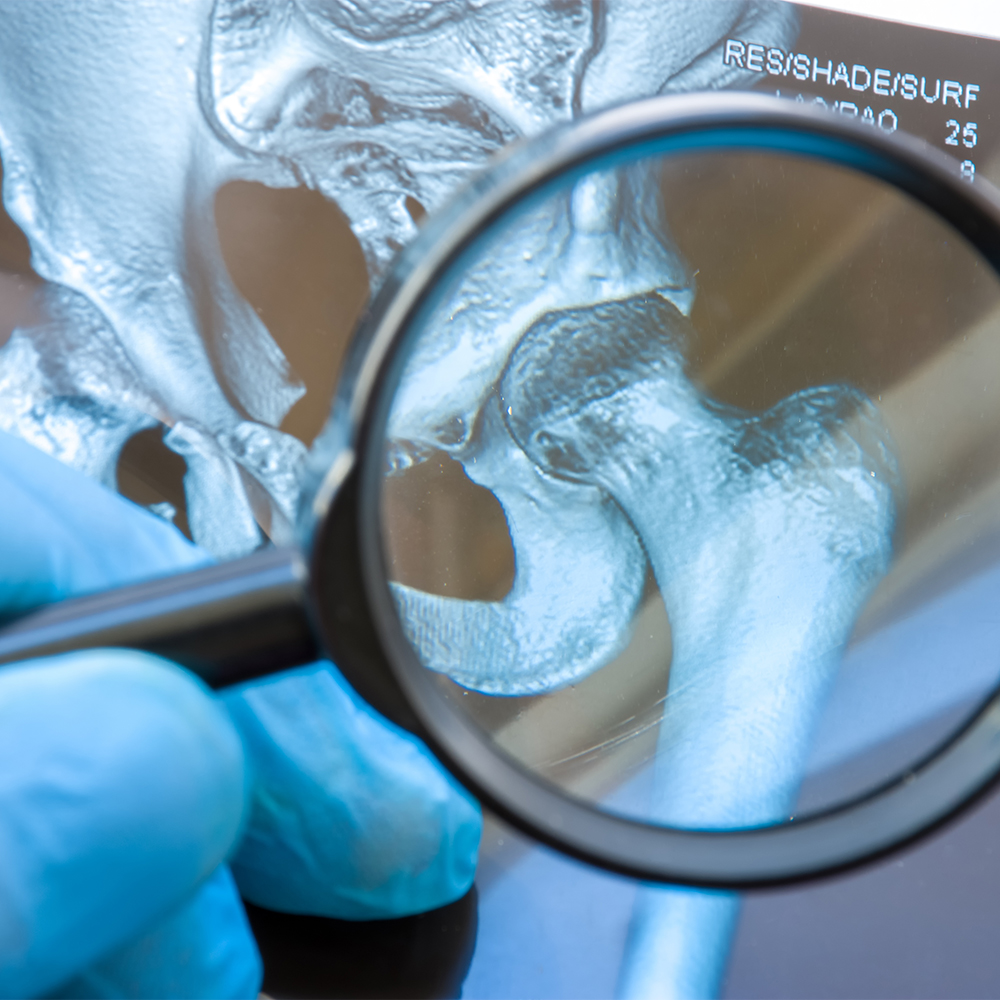 Careful diagnosis rare and occurs widely hip joint diseases such as chronic pain, arthritis, osteoarthritis, rheumatoid, dysplasia